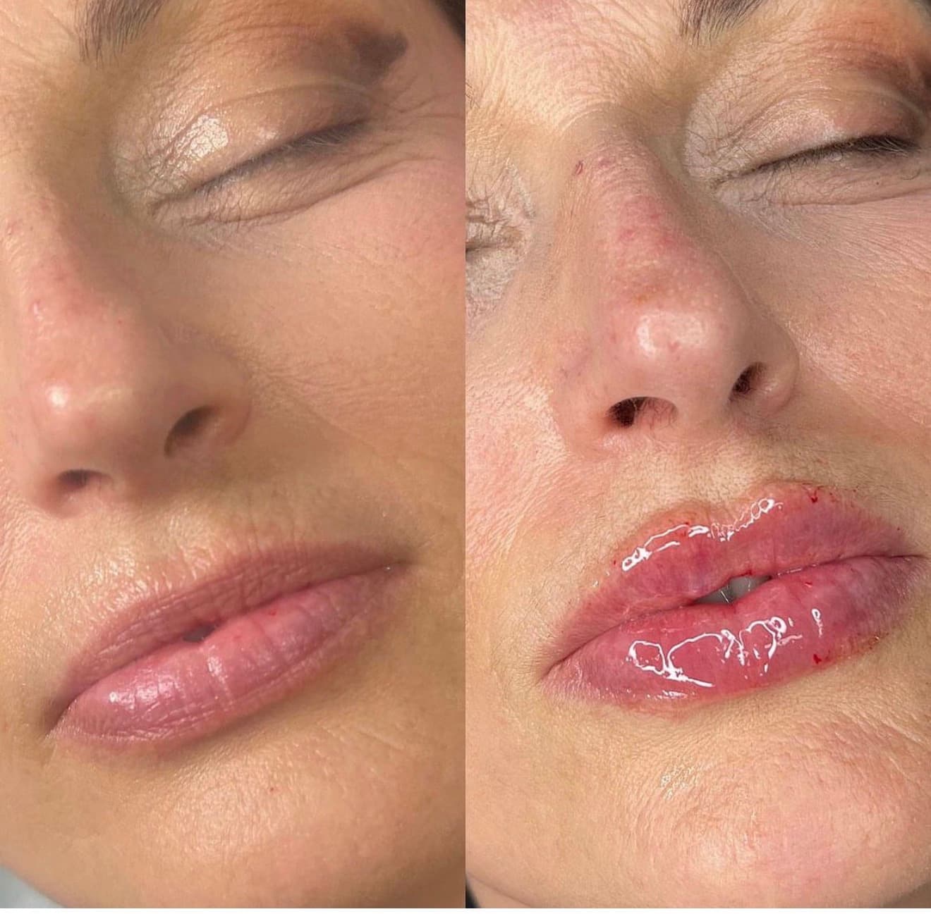 Lip Enhancement