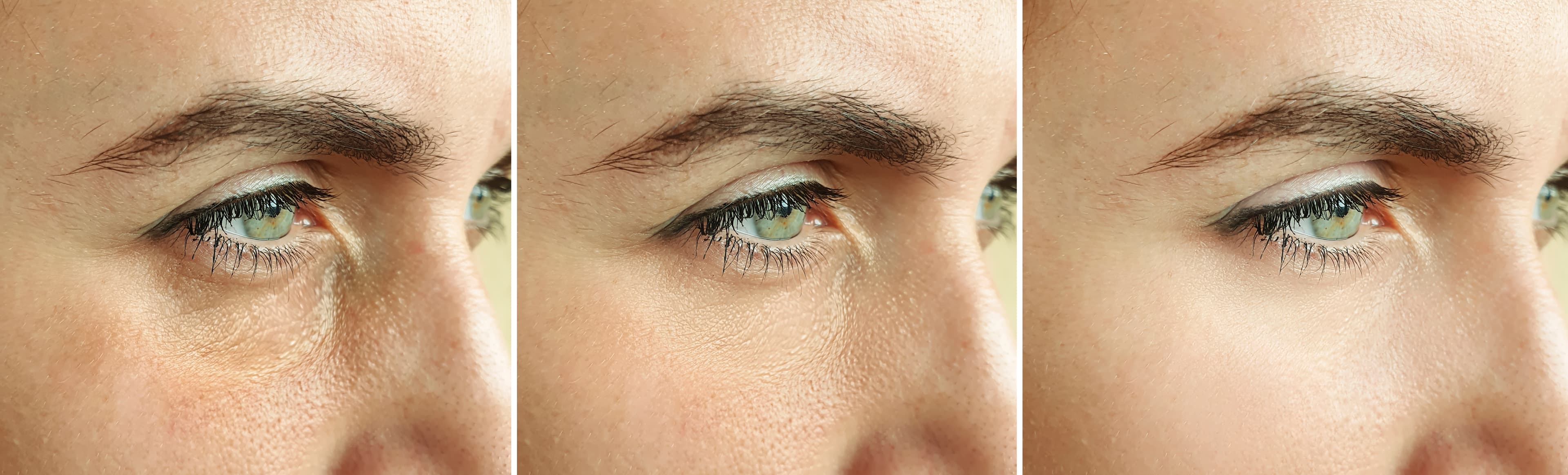 Under Eye · Tear Trough